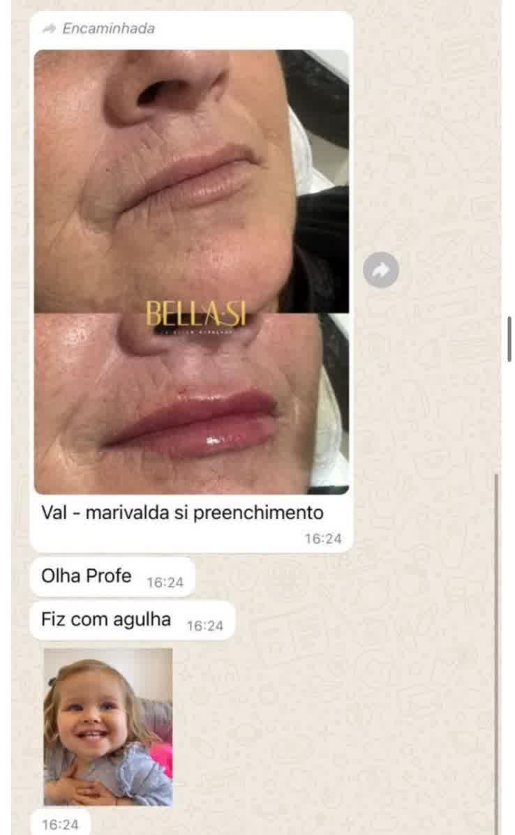 Depoimento 1 — preenchimento labial