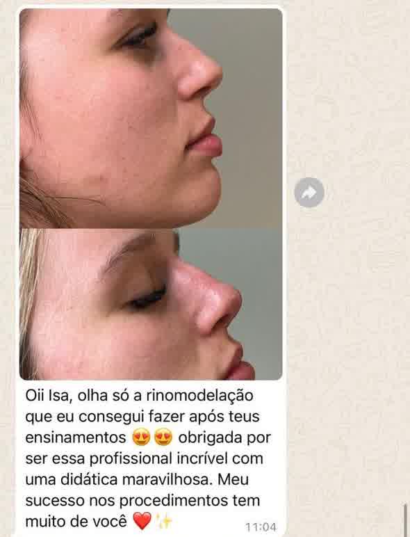 Depoimento 2 — rinomodelação