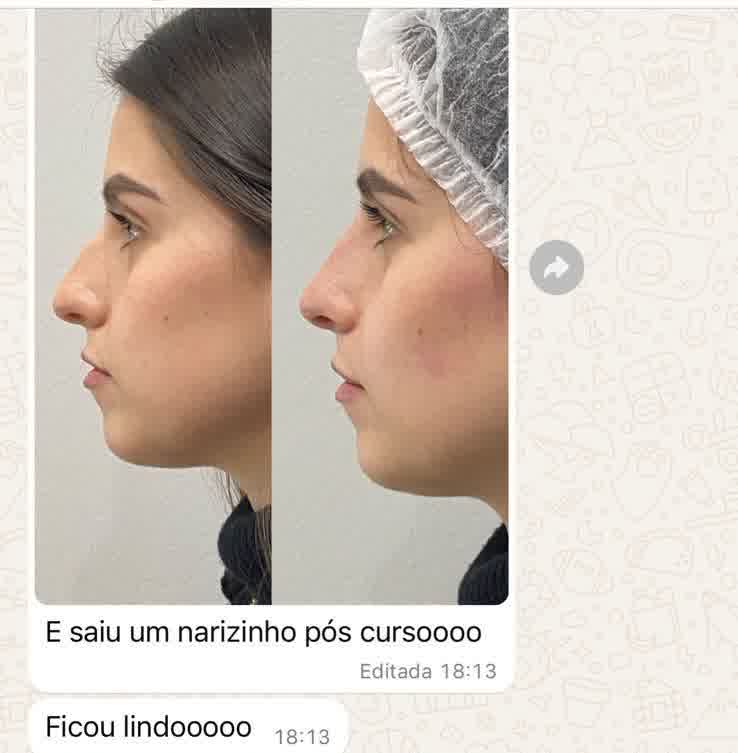 Depoimento 3 — preenchimento labial com agulha